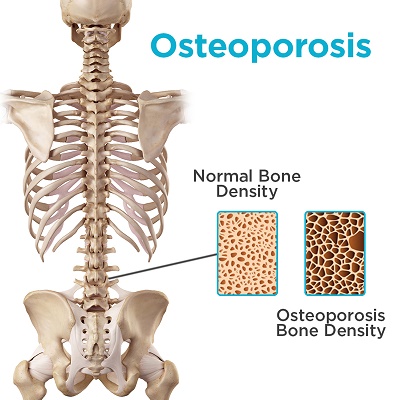 Osteoporosis vs. Normal Bone Density